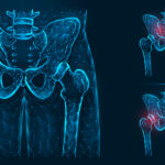 Total Hip Replacement