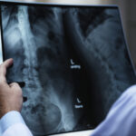 Total Hip Replacement