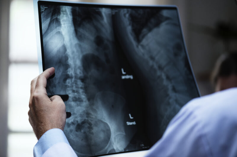 Risks and Success Rate of Total Hip Replacement