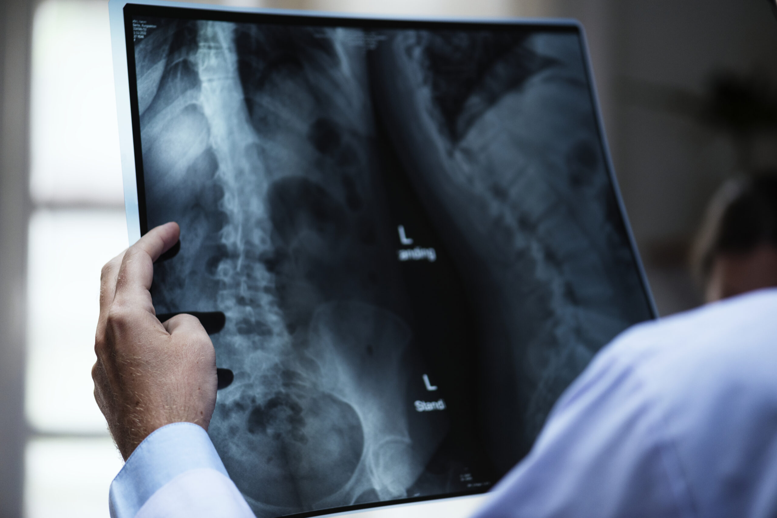 Risks and Success Rate of Total Hip Replacement
