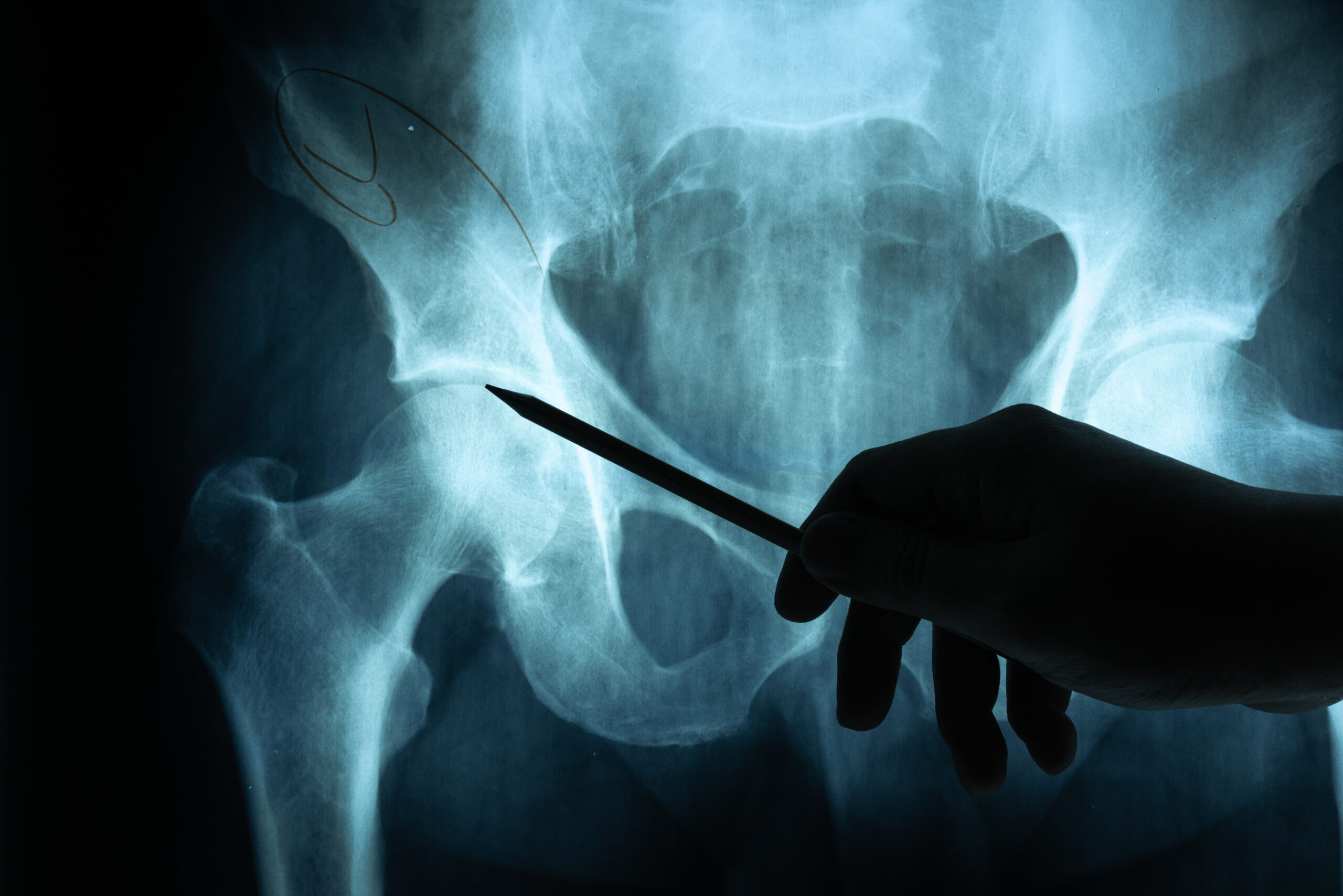Total Hip Replacement