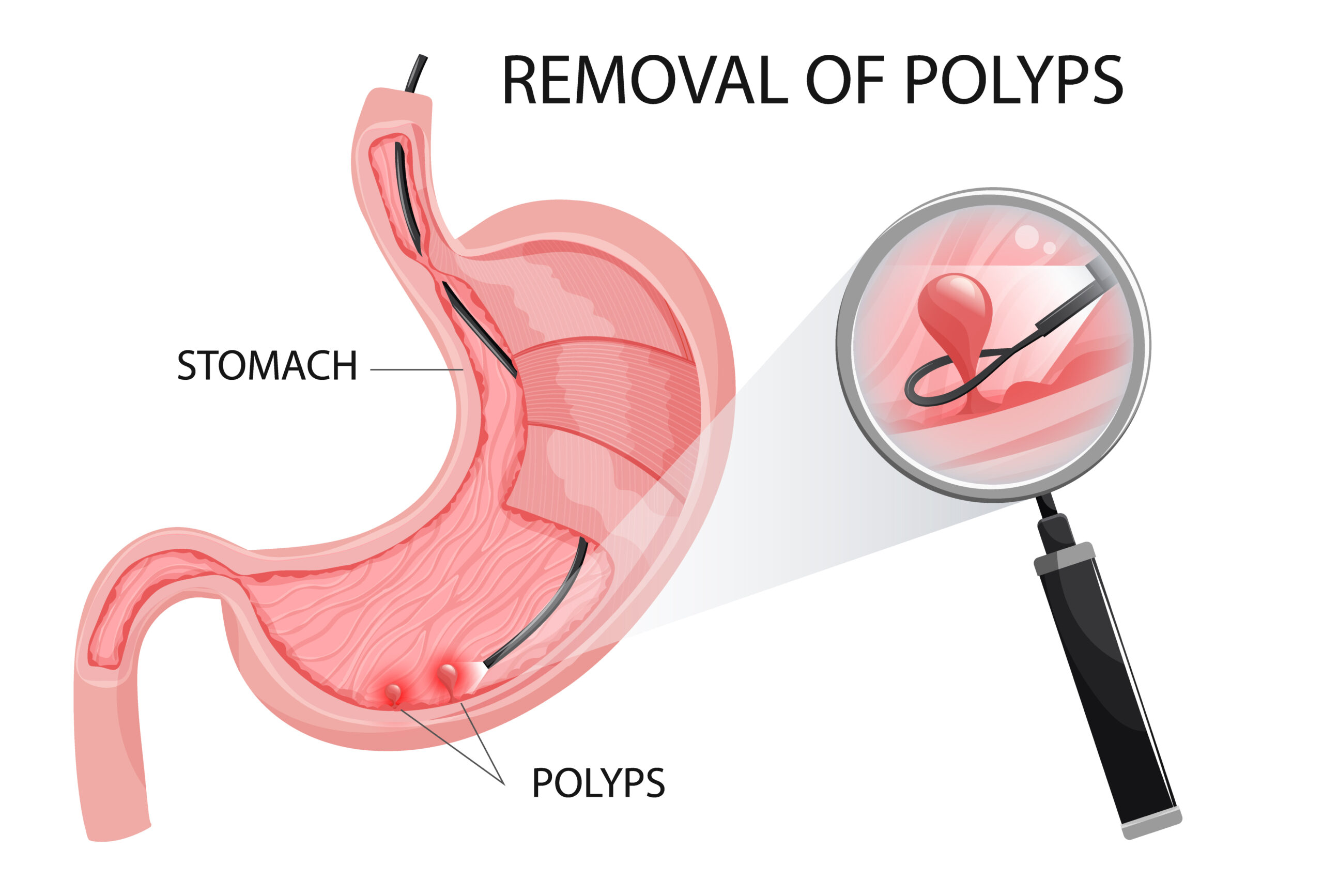 Endoscopy