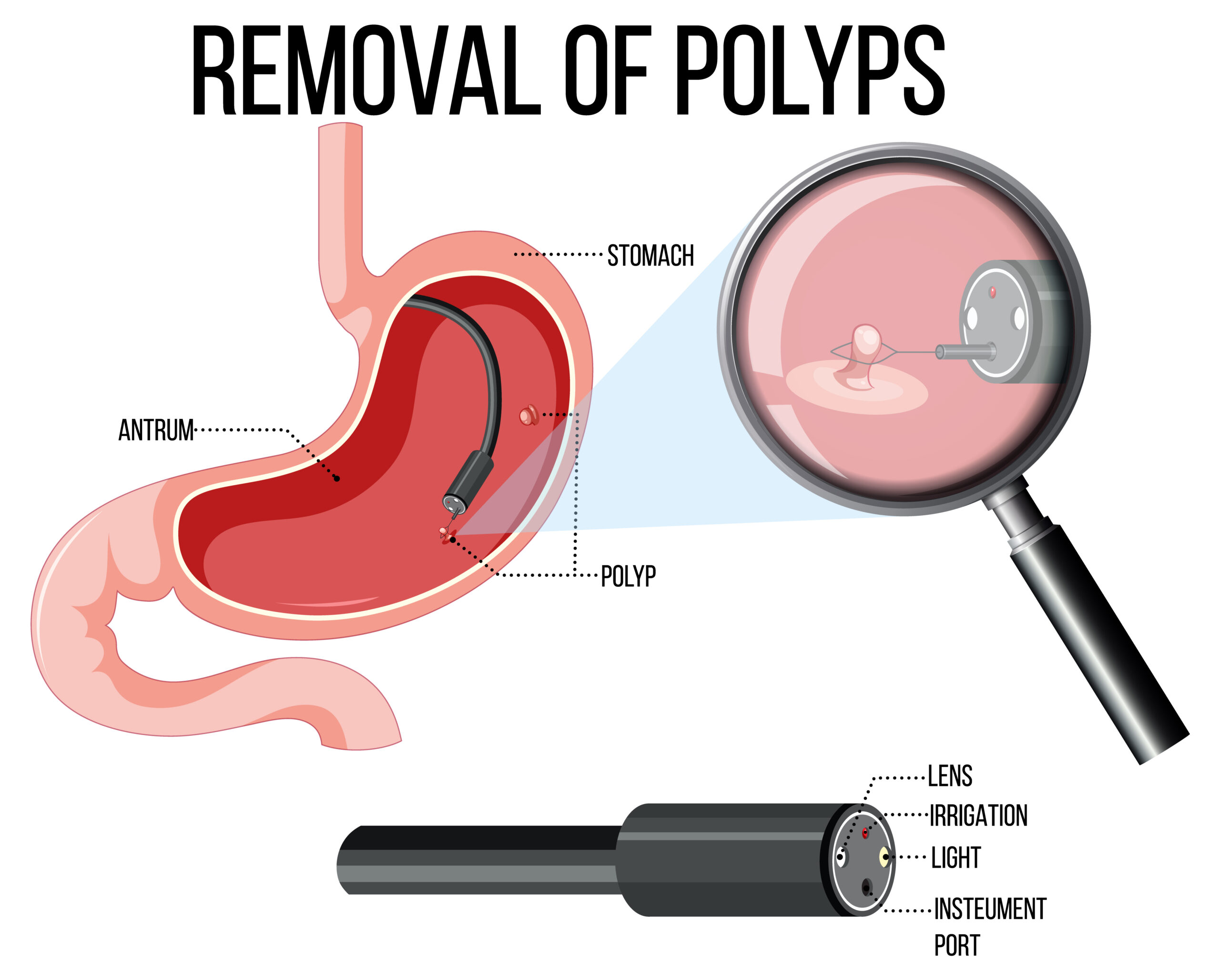 Endoscopy