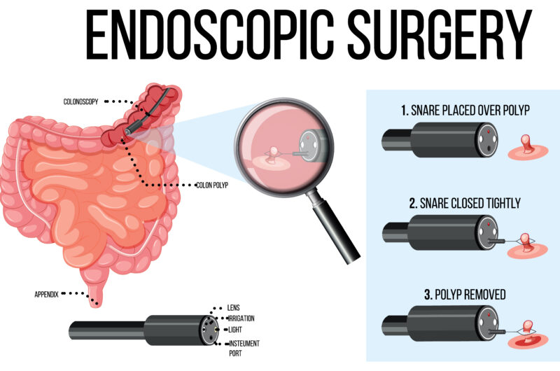 Common Misconceptions About Endoscopy: Debunking Myths and Facts