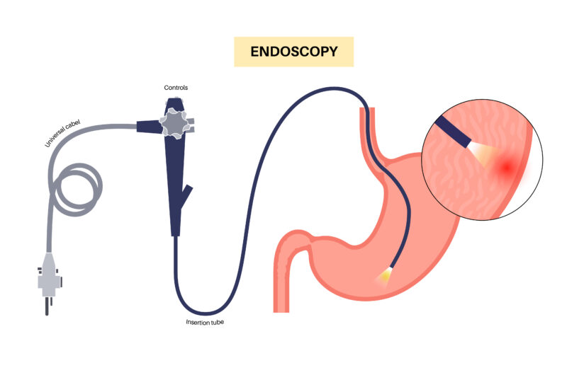 The Top 5 Endoscopy Procedures Everyone Should Know About