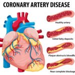 Coronary Artery