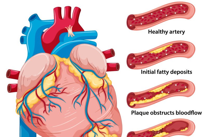 What Is Coronary Artery Disease?