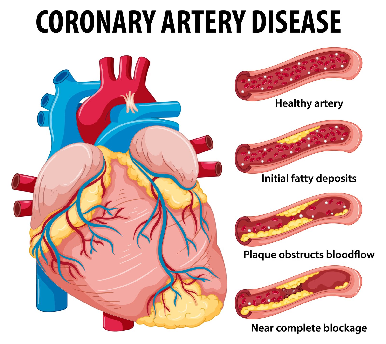 What Is Coronary Artery Disease?