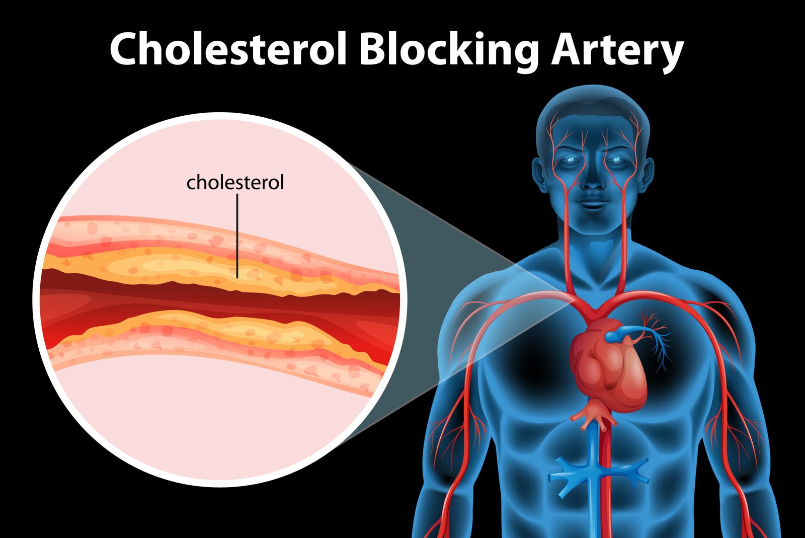 Coronary Artery